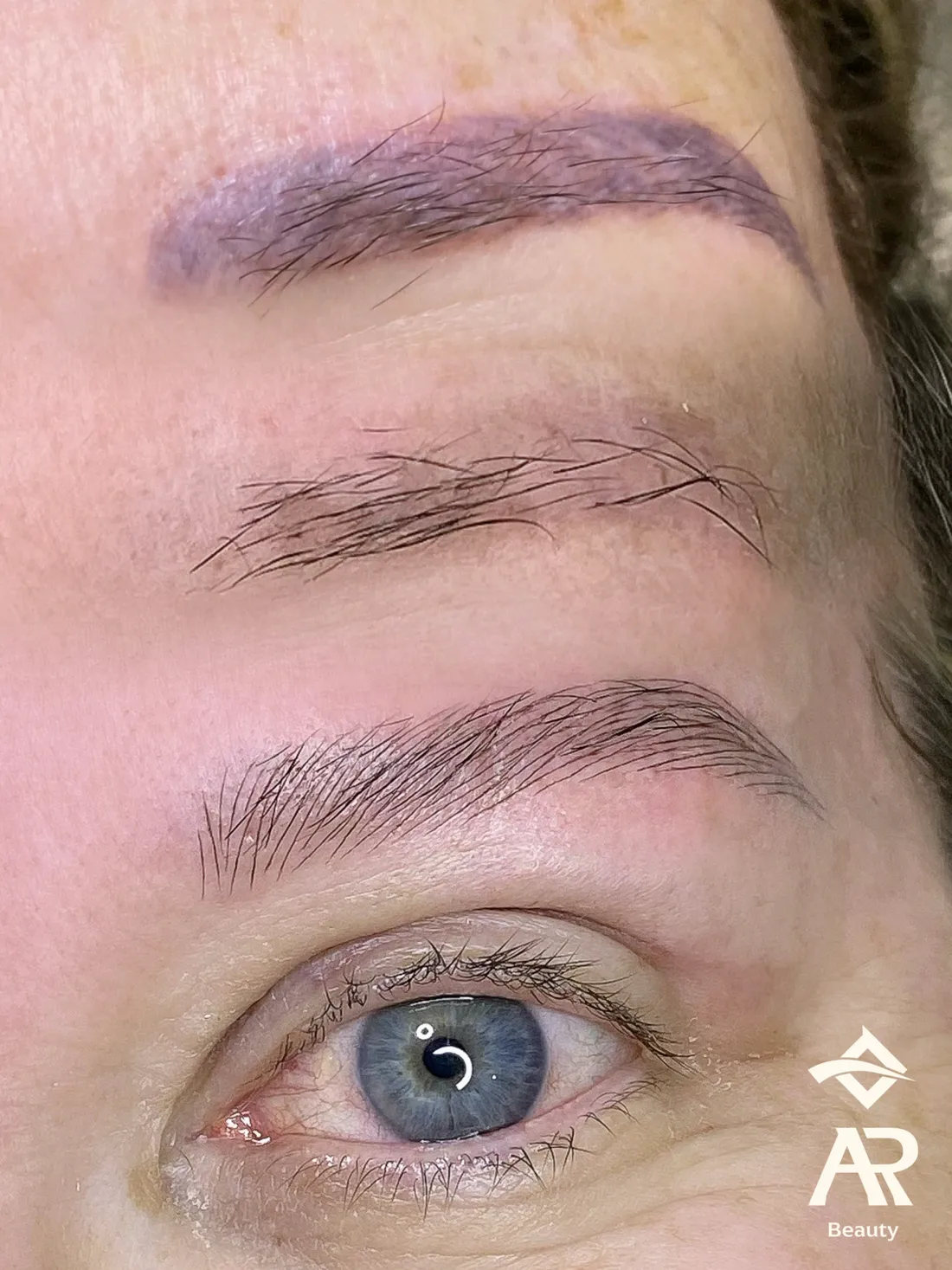 Resultado real de remoção a laser