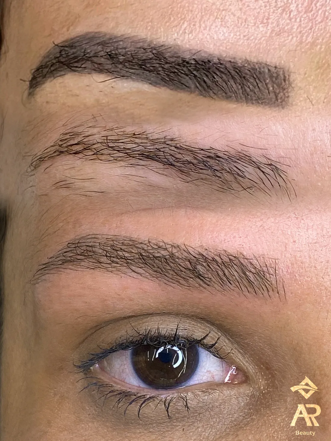 Resultado real de remoção a laser