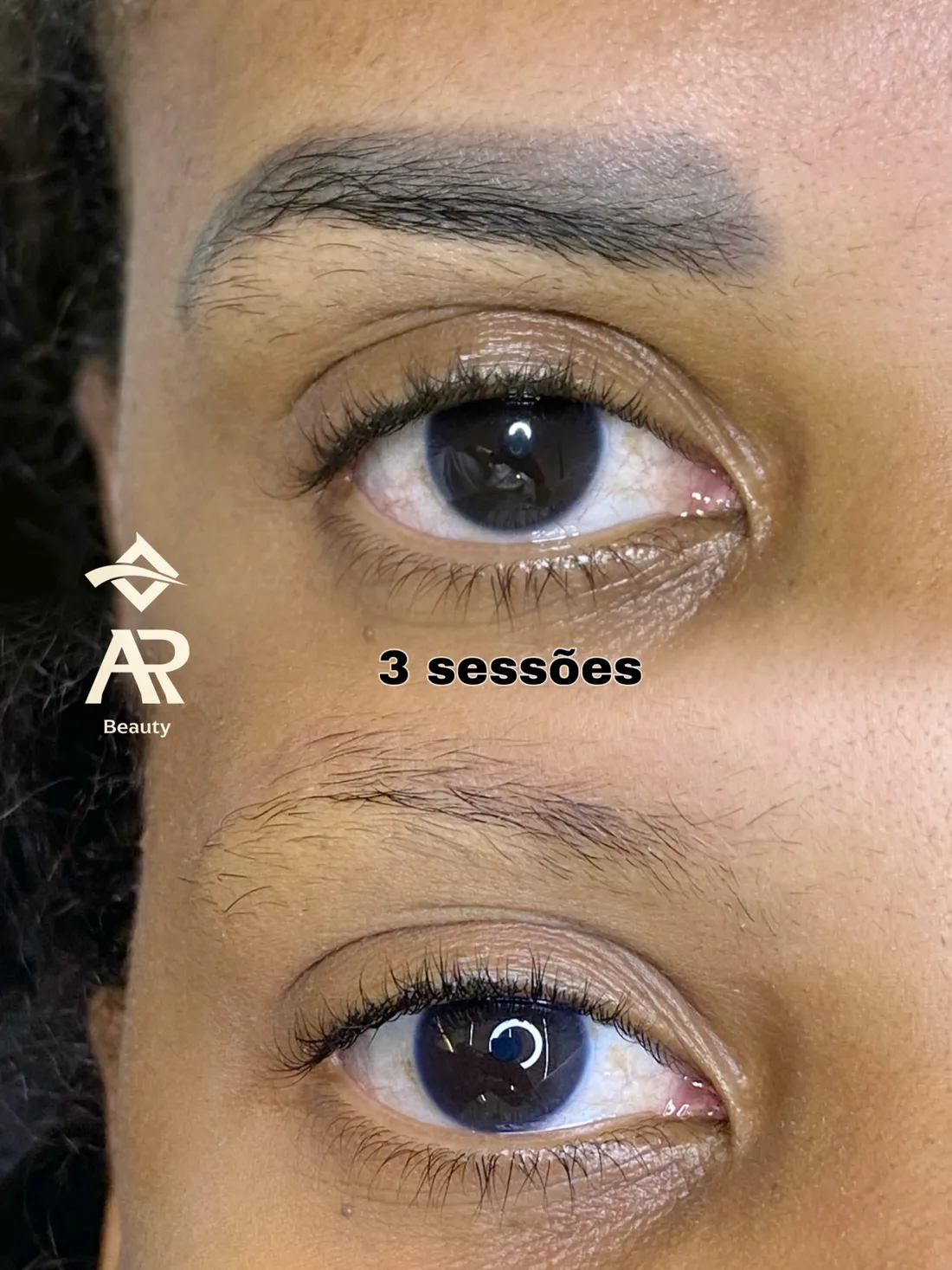Resultado real de remoção a laser