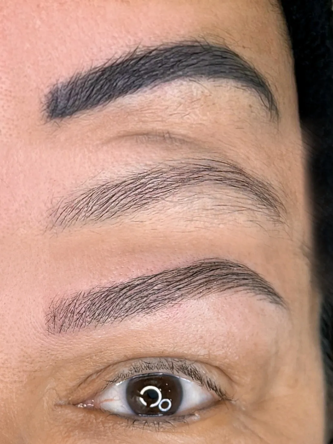Resultado real de remoção a laser